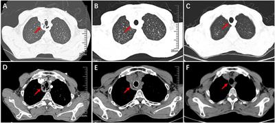 Airway necrosis and granulation tissue formation caused by Rhizopus oryzae leading to severe upper airway obstruction: a case report